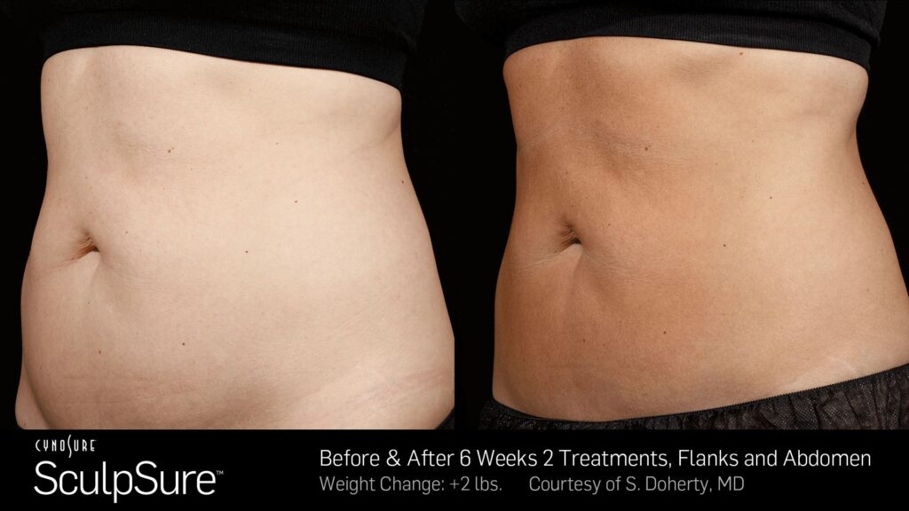 SculpSure® Before & After Photos — before and after photograph