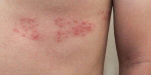 Shingles