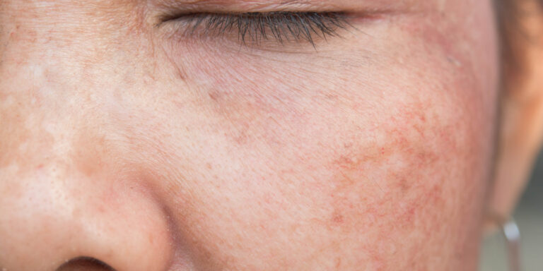 woman with sun damage on her face