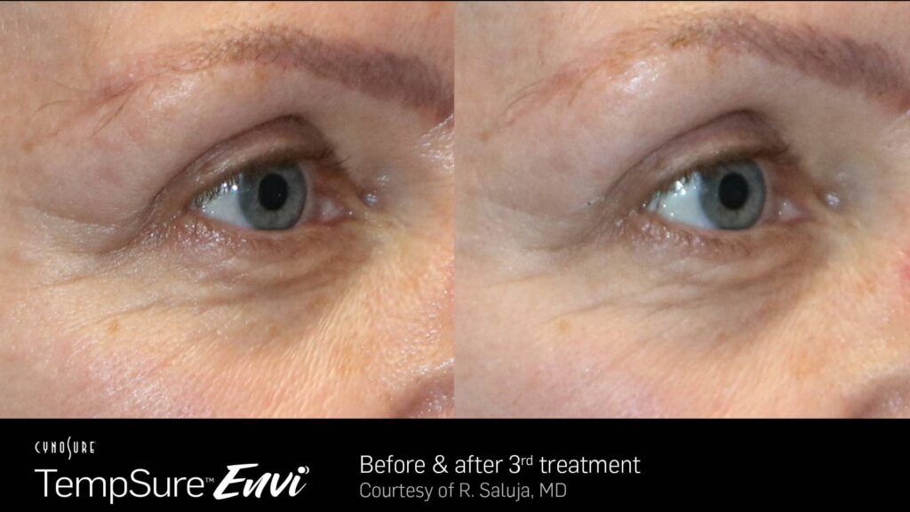 TempSure™ Envi Before & After Photos — before and after photograph