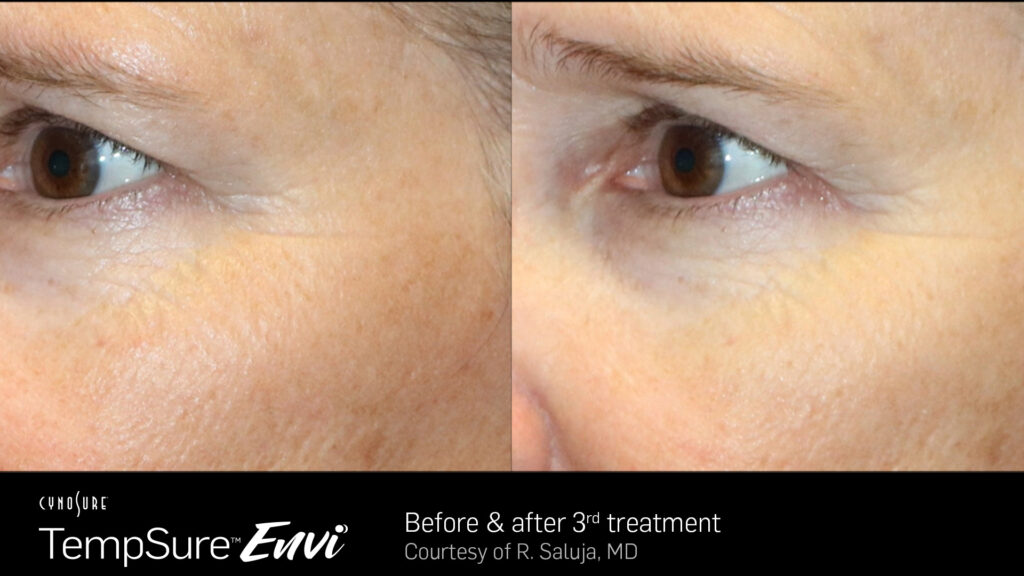 TempSure™ Envi Before & After Photos — before and after photograph