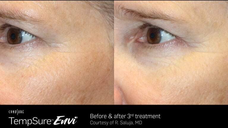 TempSure-Envi-Before-and-After-Image15.jpg