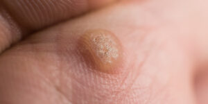 Warts