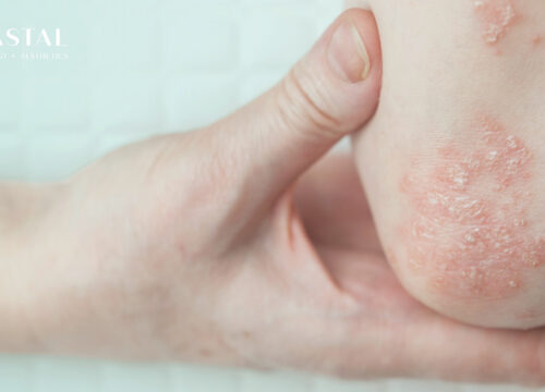 Understanding Psoriasis: Causes, Triggers, and Treatment Options on the Central Coast