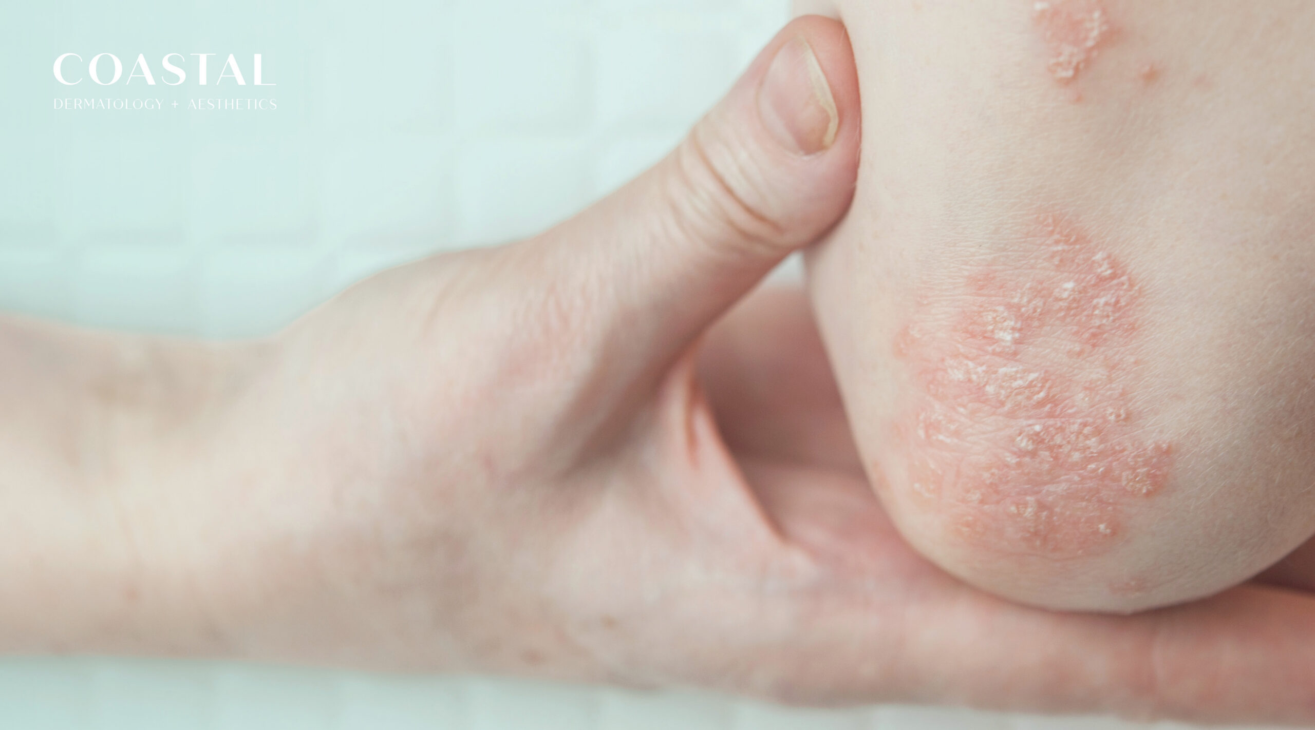Understanding Psoriasis: Causes, Triggers, and Treatment Options on the Central Coast