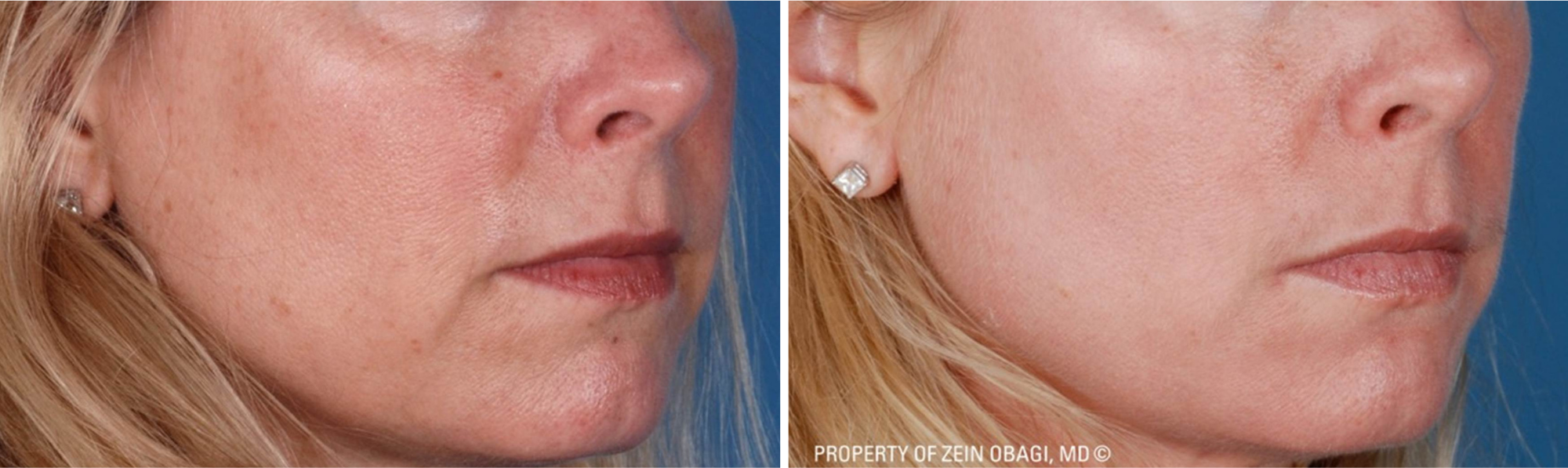 before & after zo skin health
