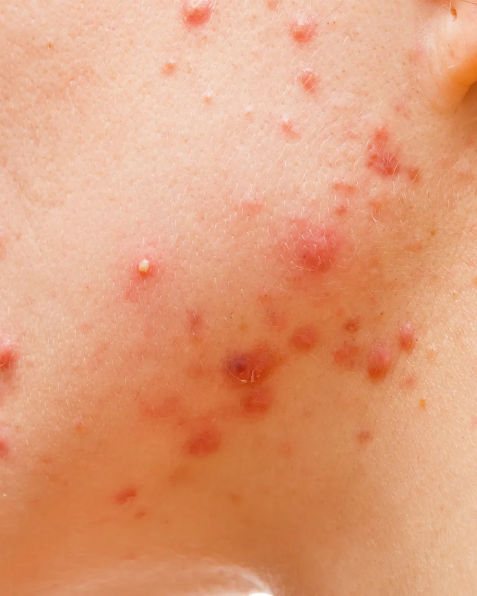 Close-up on acne and acne scarring