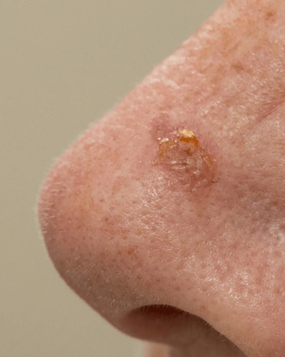 Close-up on actinic keratosis