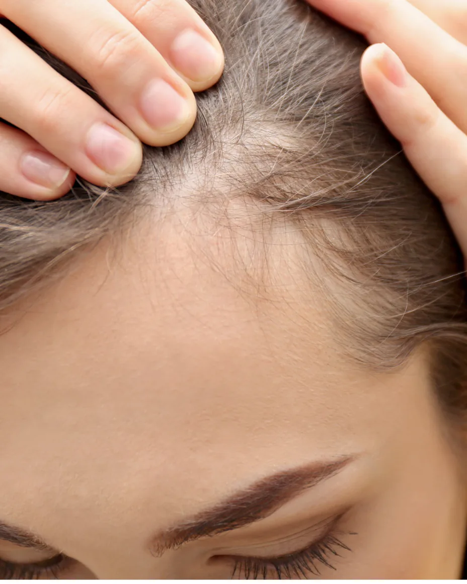 Woman suffering from alopecia