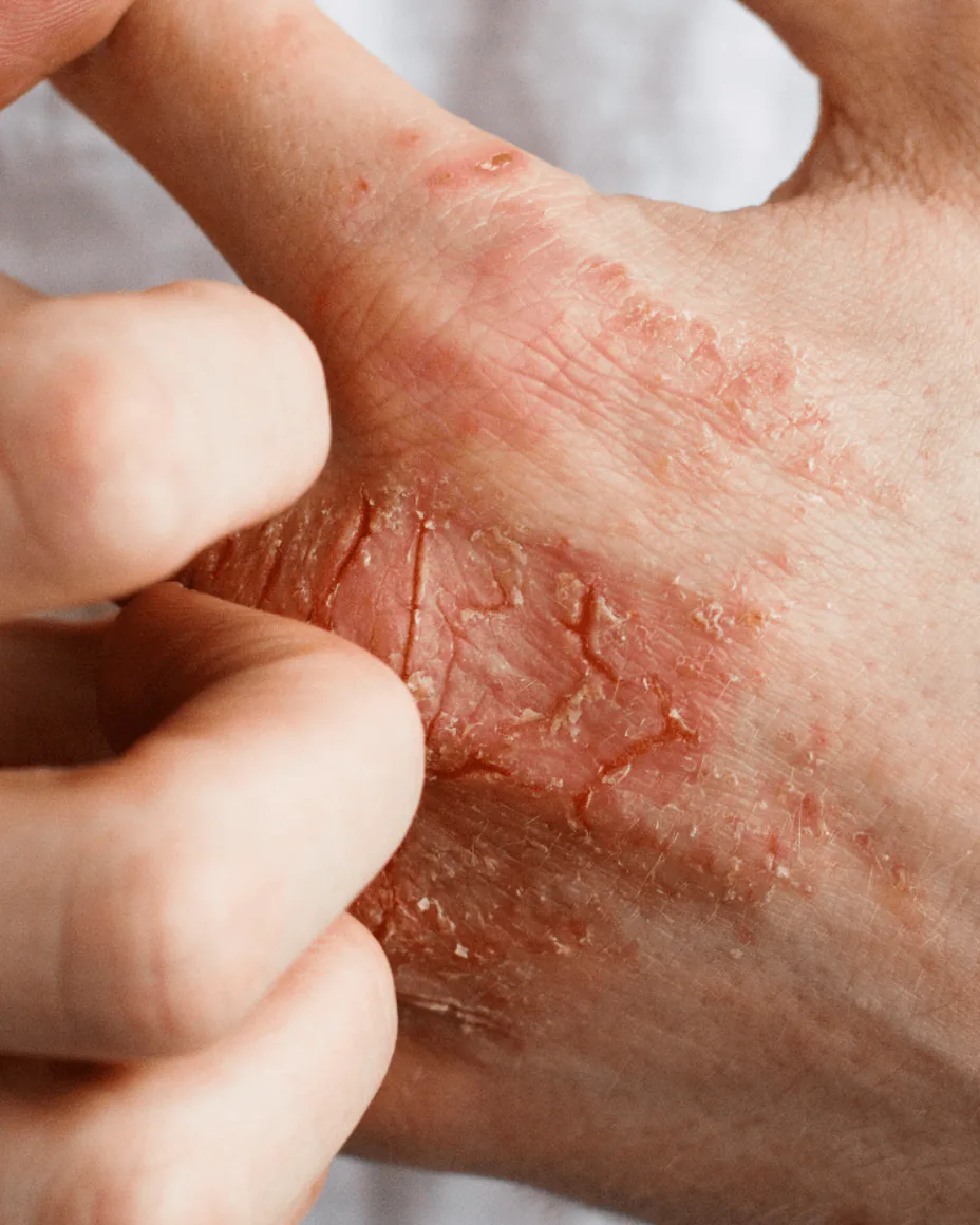 Eczema