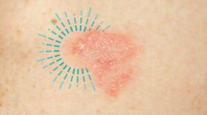 Eczema in the Fall