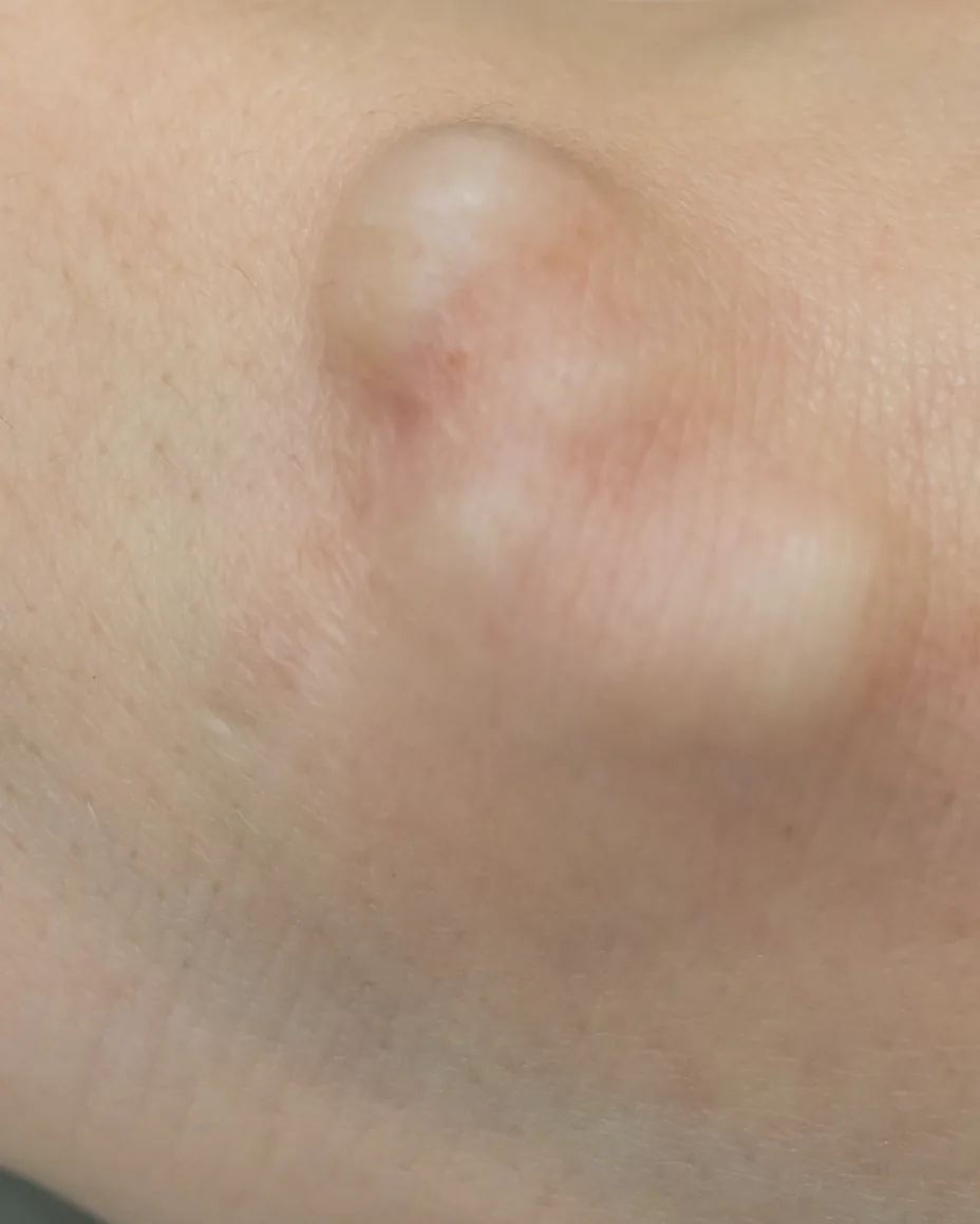 A cyst