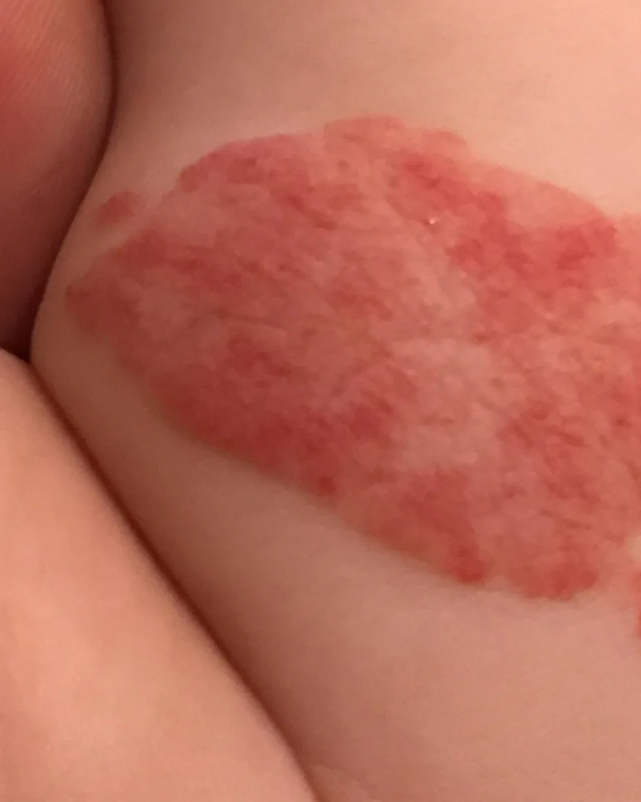 Infantile Hemangiomas