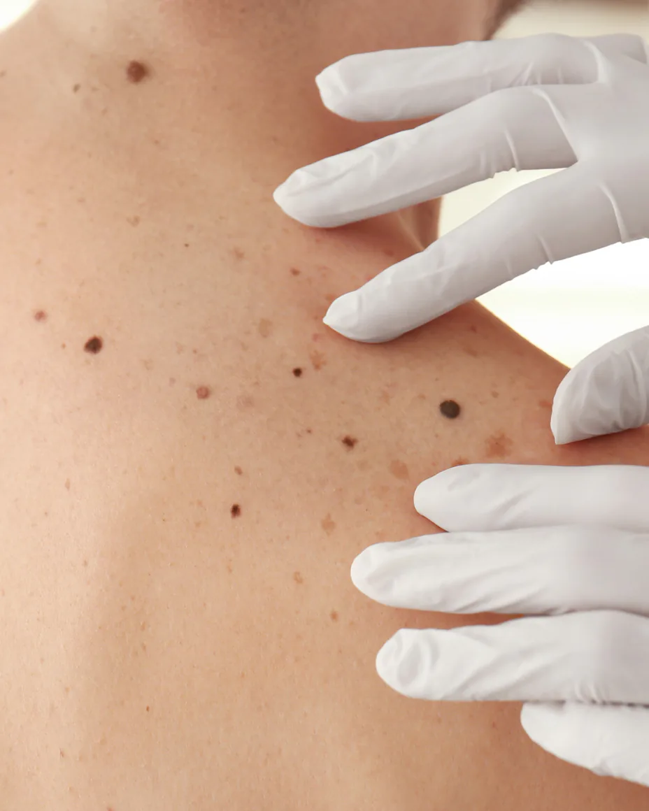 moles on the back