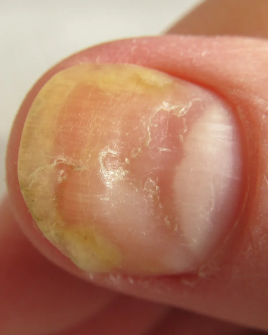 a nail disorder in the thumb