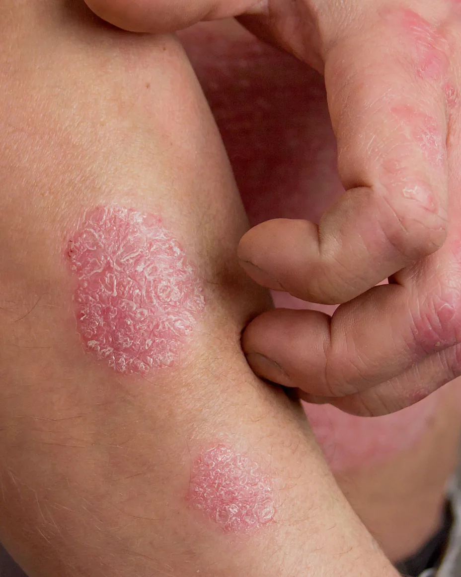 Psoriasis on the arms