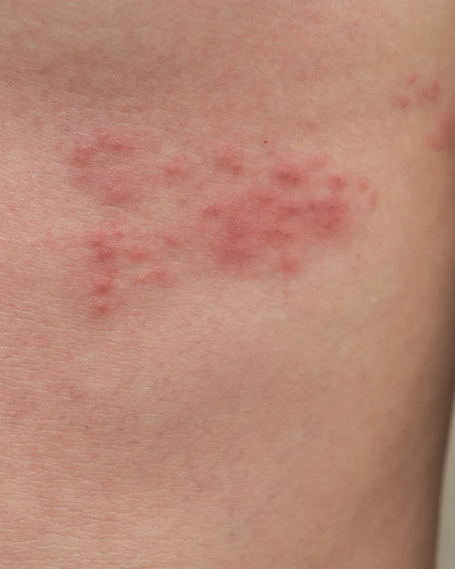 Shingles on the legs