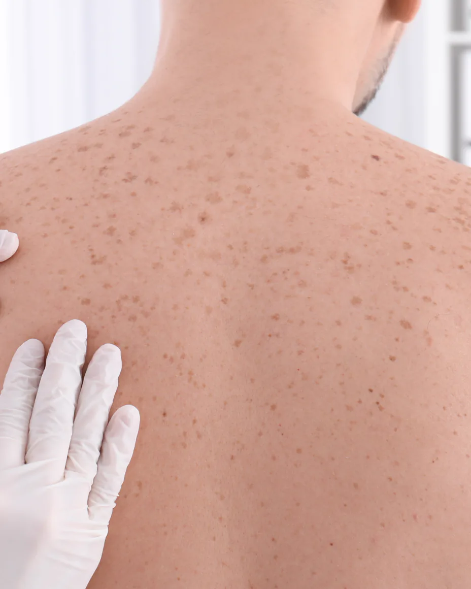 Man's back being checked for skin cancer