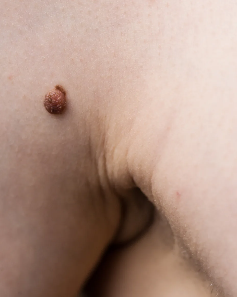Skin tag on a woman's arm