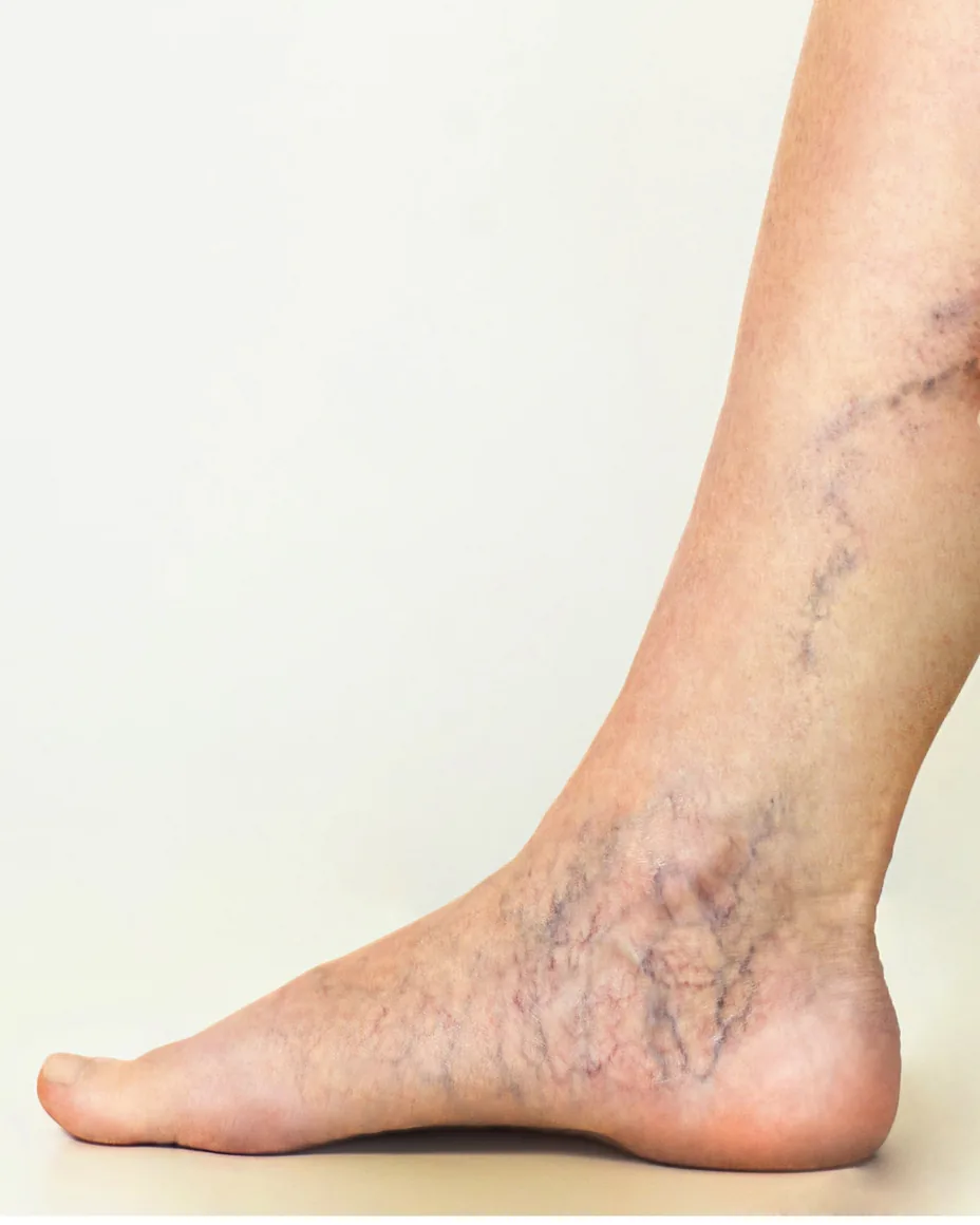 leg with spider veins