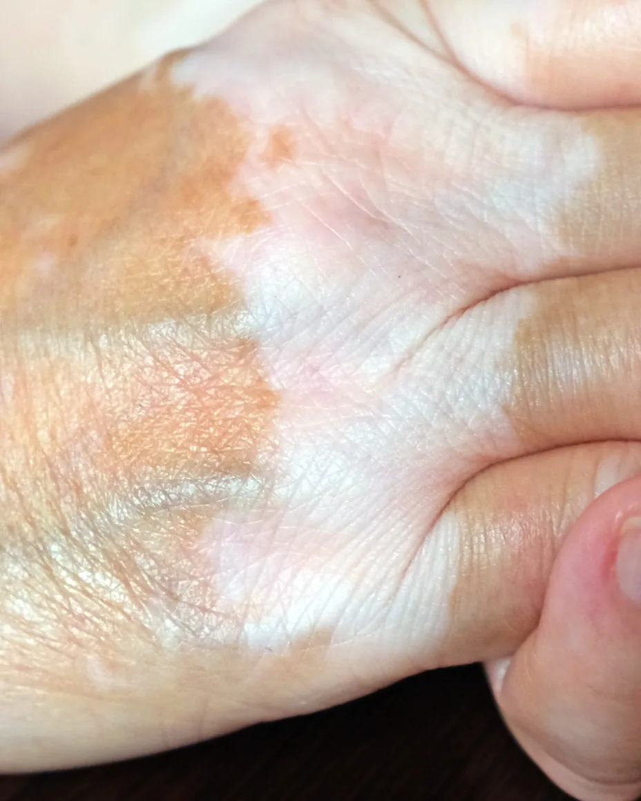 vitiligo on hands
