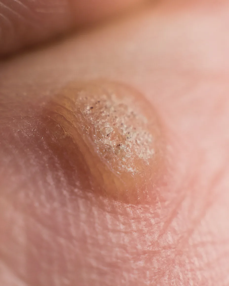 large wart on finger