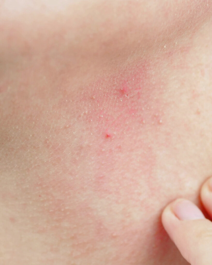 contact-dermatitis