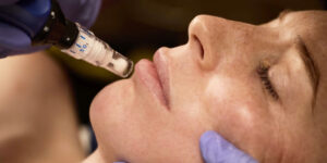 SkinPen® Microneedling