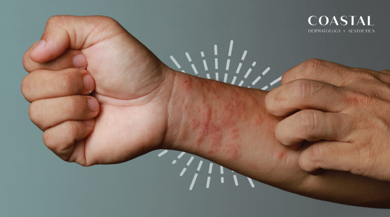 Learn about eczema symptoms and treatment at Coastal Dermatology + Aesthetics in San Luis Obispo. Get personalized care for dry, itchy, irritated skin.